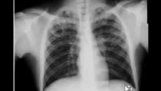 AI detects tuberculosis 